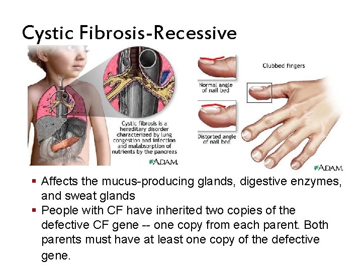 Cystic Fibrosis-Recessive § Affects the mucus-producing glands, digestive enzymes, and sweat glands § People