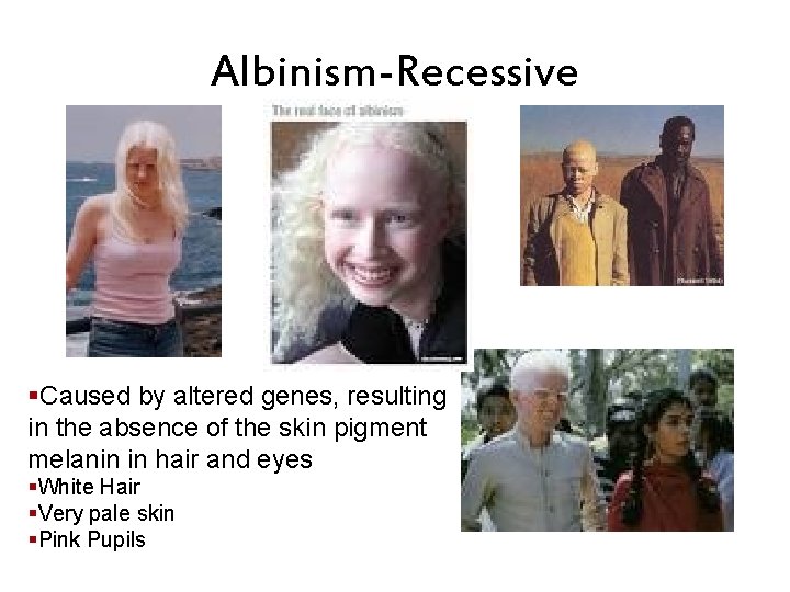 Albinism-Recessive §Caused by altered genes, resulting in the absence of the skin pigment melanin