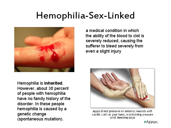 Hemophilia-Sex-Linked a medical condition in which the ability of the blood to clot is