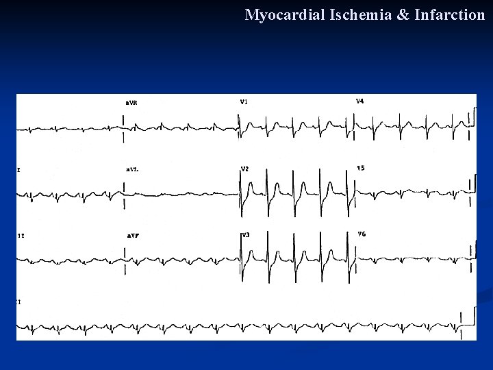 Myocardial Ischemia & Infarction Myocardial Ischemia & Infarction