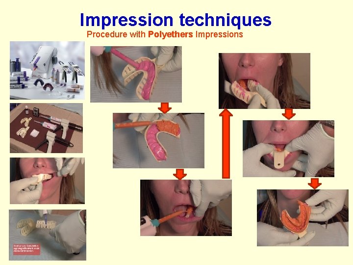 Impression techniques Procedure with Polyethers Impressions Impression techniques Procedure with Polyethers Impressions