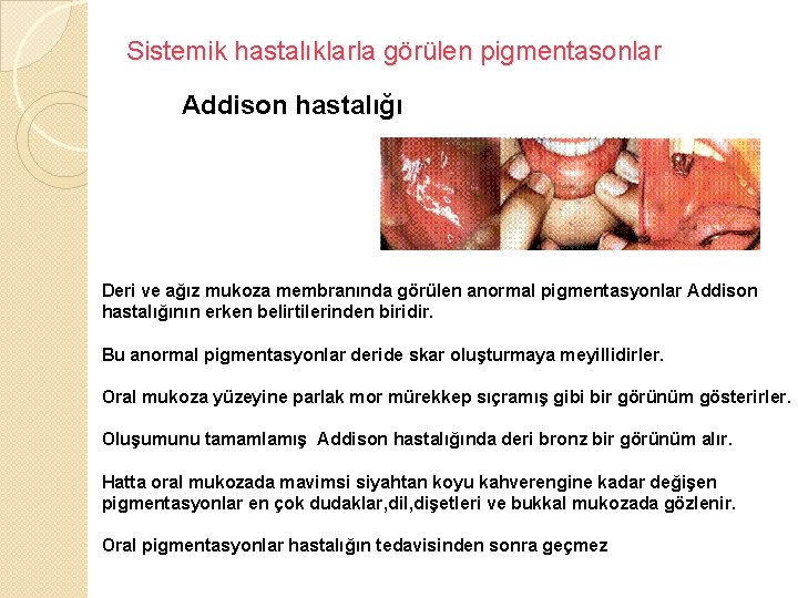 Sistemik hastalıklarla görülen pigmentasonlar Addison hastalığı Deri ve ağız mukoza membranında görülen anormal pigmentasyonlar