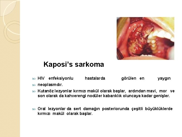 Kaposi’s sarkoma HIV enfeksiyonlu hastalarda görülen en yaygın neoplasmdır. Kutanöz lezyonlar kırmızı makül olarak