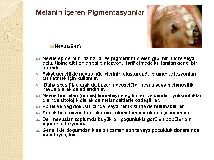 Melanin İçeren Pigmentasyonlar Nevus(Ben) Nevus epidermis, damarlar ve pigment hücreleri gibi bir hücre veya