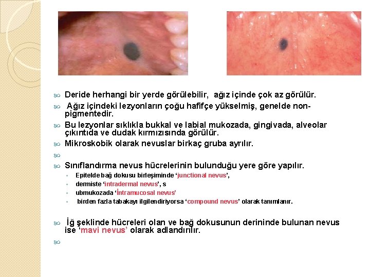 Deride herhangi bir yerde görülebilir, ağız içinde çok az görülür. Ağız içindeki lezyonların çoğu