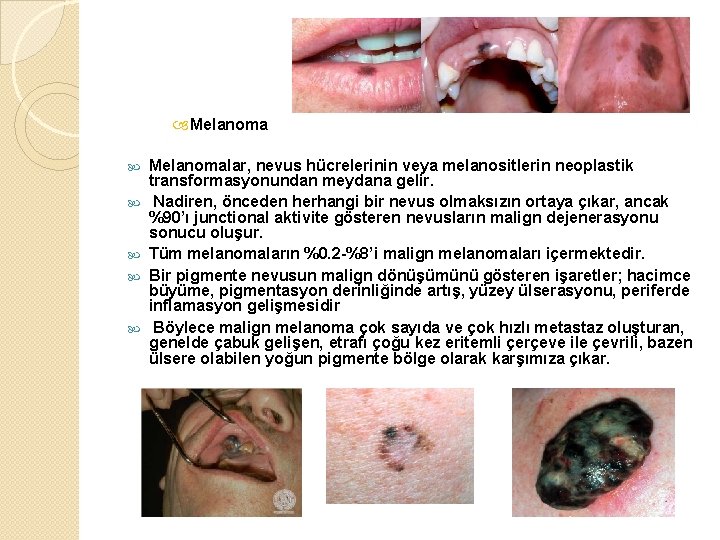  Melanoma Melanomalar, nevus hücrelerinin veya melanositlerin neoplastik transformasyonundan meydana gelir. Nadiren, önceden herhangi