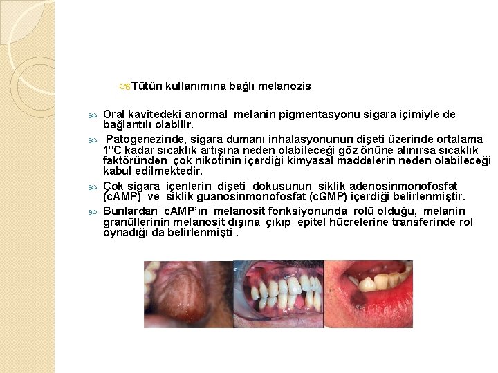  Tütün kullanımına bağlı melanozis Oral kavitedeki anormal melanin pigmentasyonu sigara içimiyle de bağlantılı