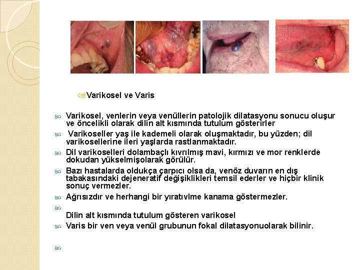  Varikosel ve Varis Varikosel, venlerin veya venüllerin patolojik dilatasyonu sonucu oluşur ve öncelikli