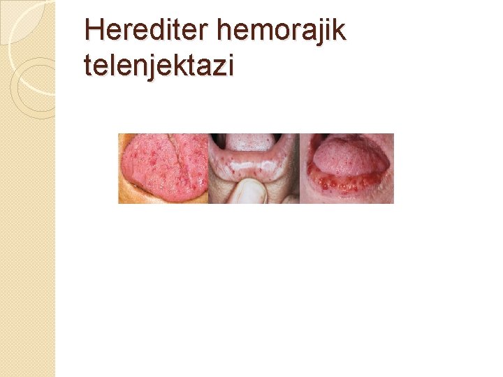 Herediter hemorajik telenjektazi 