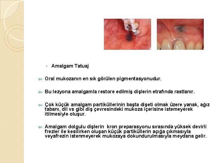 ◦ Amalgam Tatuaj Oral mukozanın en sık görülen pigmentasyonudur. Bu lezyona amalgamla restore edilmiş