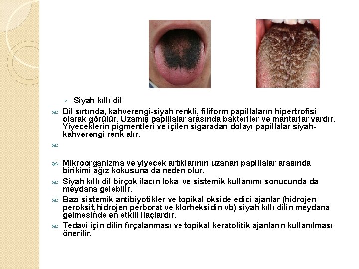 ◦ Siyah kıllı dil Dil sırtında, kahverengi-siyah renkli, filiform papillaların hipertrofisi olarak görülür. Uzamış