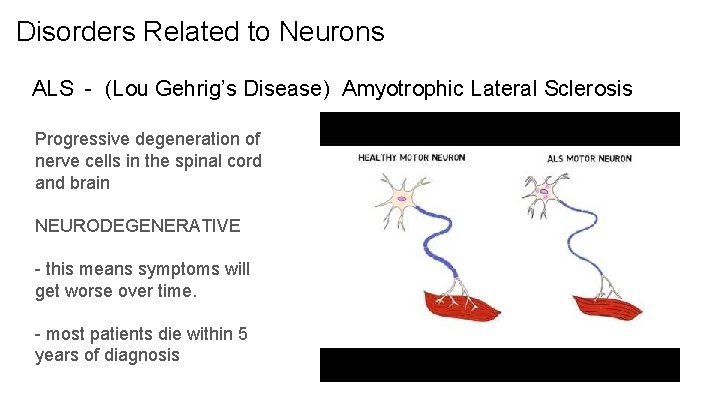 Disorders Related to Neurons ALS - (Lou Gehrig’s Disease) Amyotrophic Lateral Sclerosis Progressive degeneration