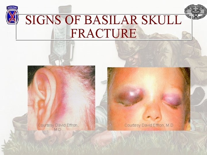 SIGNS OF BASILAR SKULL FRACTURE Courtesy David Effron, M. D. 