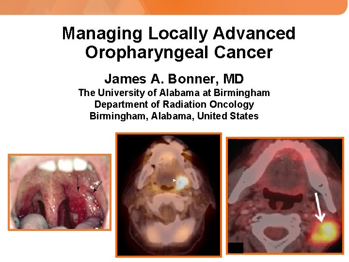 Managing Locally Advanced Oropharyngeal Cancer James A. Bonner, MD The University of Alabama at