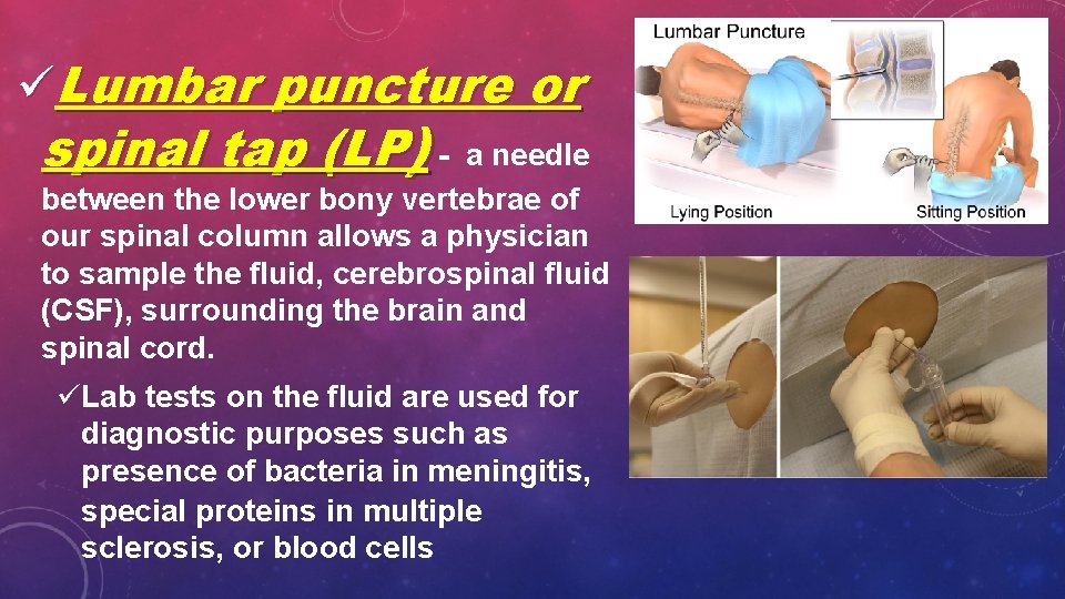 üLumbar puncture or spinal tap (LP) - a needle between the lower bony vertebrae