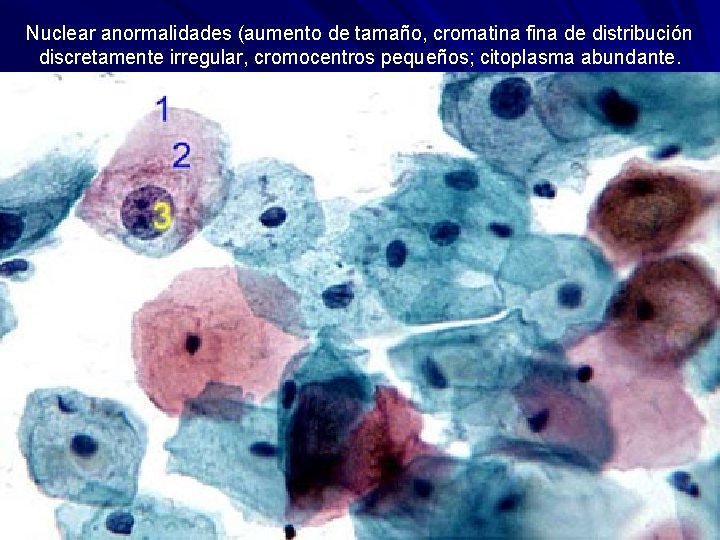 Nuclear anormalidades (aumento de tamaño, cromatina fina de distribución discretamente irregular, cromocentros pequeños; citoplasma