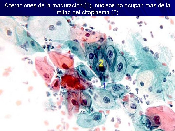 Alteraciones de la maduración (1); núcleos no ocupan más de la mitad del citoplasma