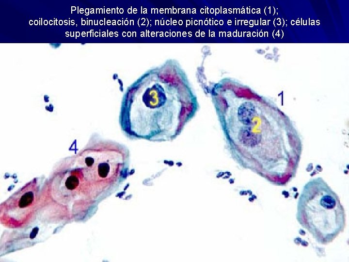 Plegamiento de la membrana citoplasmática (1); coilocitosis, binucleación (2); núcleo picnótico e irregular (3);