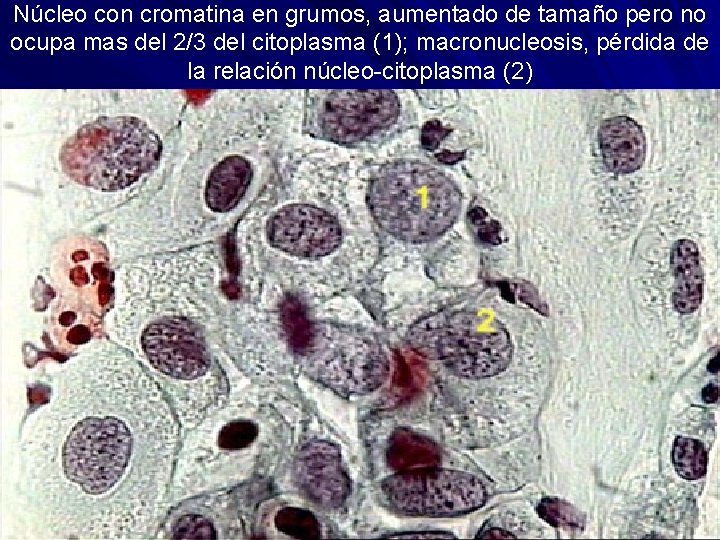 Núcleo con cromatina en grumos, aumentado de tamaño pero no ocupa mas del 2/3