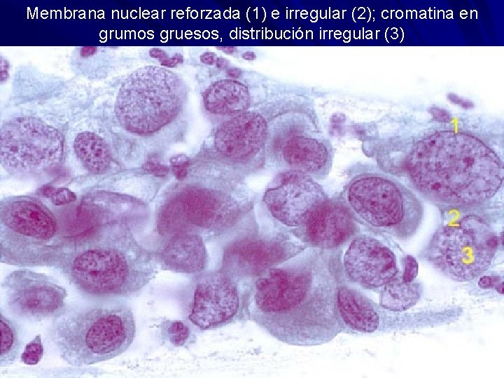 Membrana nuclear reforzada (1) e irregular (2); cromatina en grumos gruesos, distribución irregular (3)