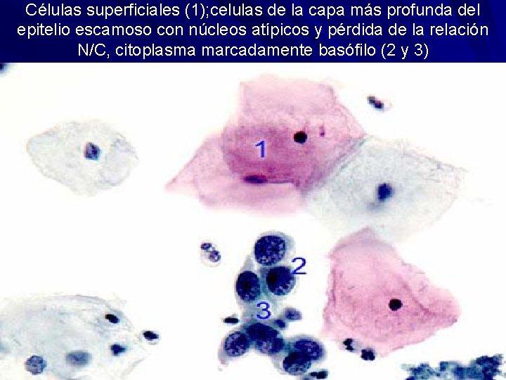 Células superficiales (1); celulas de la capa más profunda del epitelio escamoso con núcleos