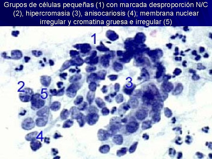 Grupos de células pequeñas (1) con marcada desproporción N/C (2), hipercromasia (3), anisocariosis (4);