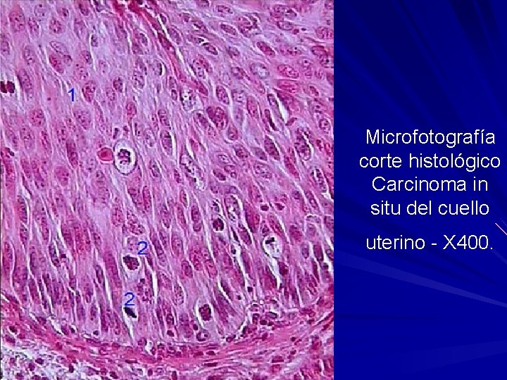 Microfotografía corte histológico Carcinoma in situ del cuello uterino - X 400. 