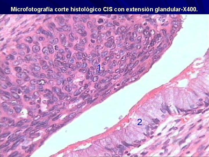 Microfotografía corte histológico CIS con extensión glandular-X 400. 