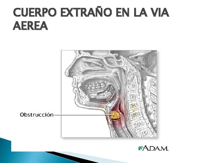 CUERPO EXTRAÑO EN LA VIA AEREA 