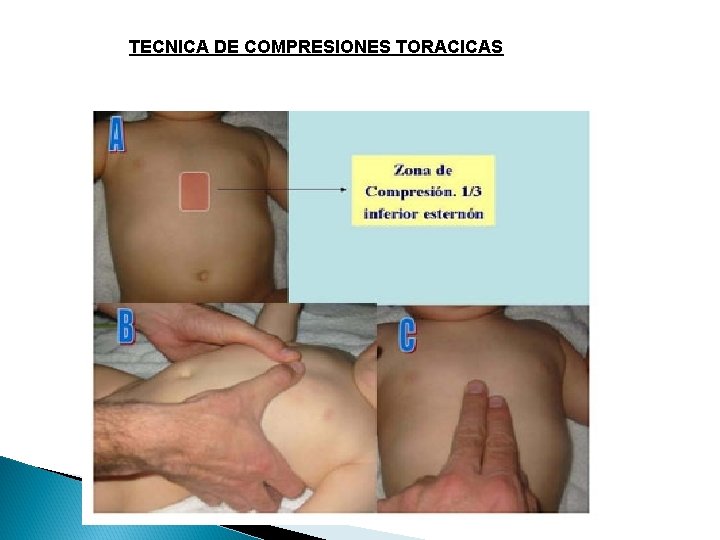 TECNICA DE COMPRESIONES TORACICAS 