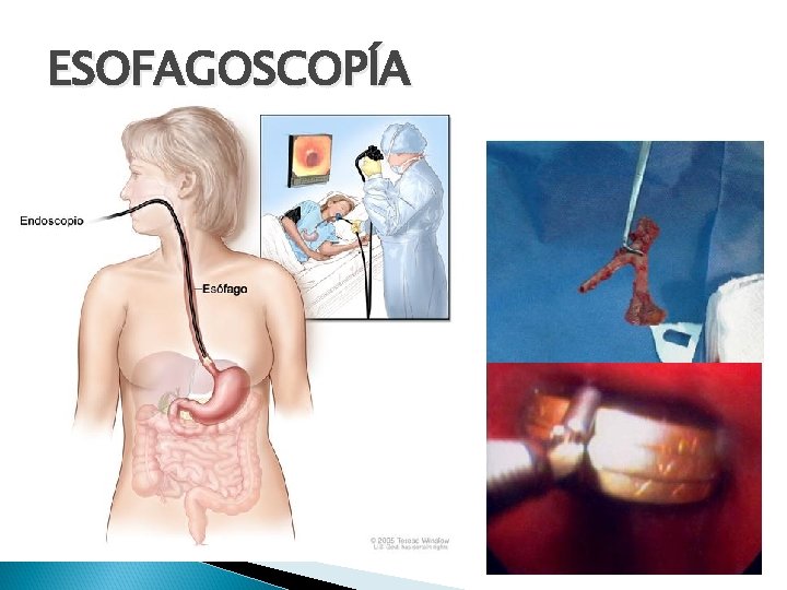 ESOFAGOSCOPÍA 