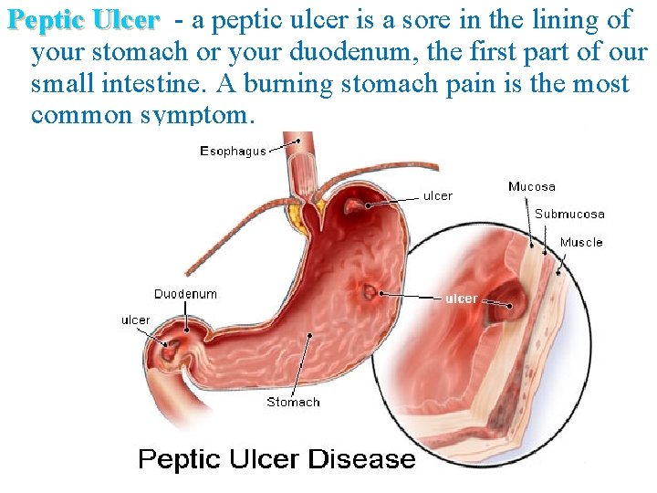 Peptic Ulcer - a peptic ulcer is a sore in the lining of your