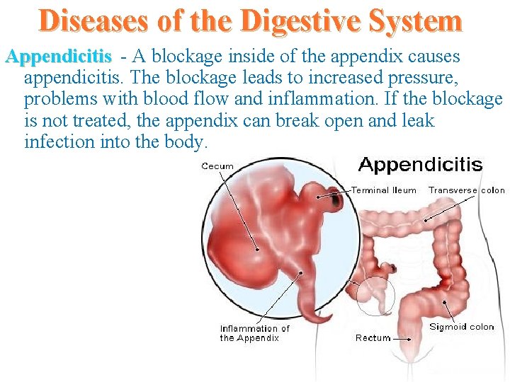 Diseases of the Digestive System Appendicitis - A blockage inside of the appendix causes
