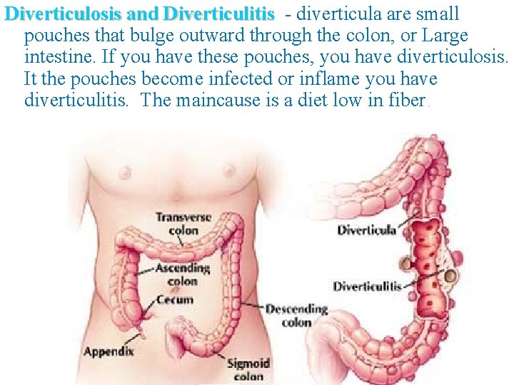 Diverticulosis and Diverticulitis - diverticula are small pouches that bulge outward through the colon,