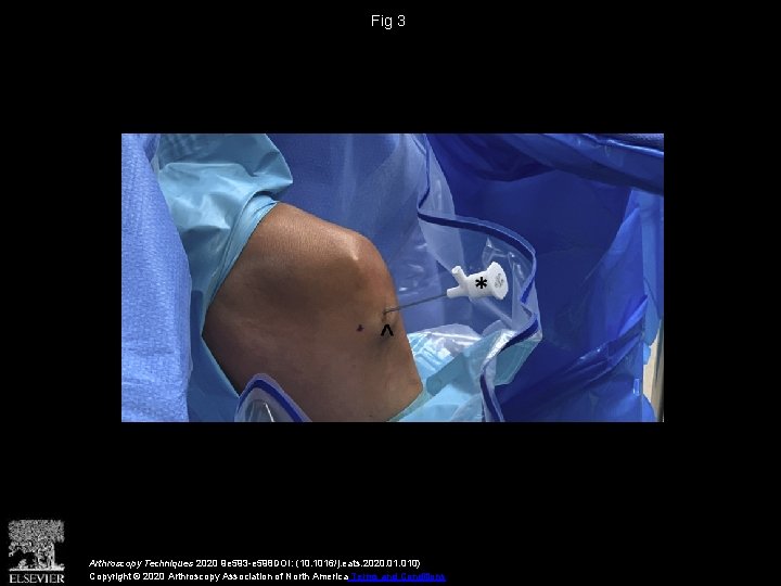 Fig 3 Arthroscopy Techniques 2020 9 e 593 -e 598 DOI: (10. 1016/j. eats.