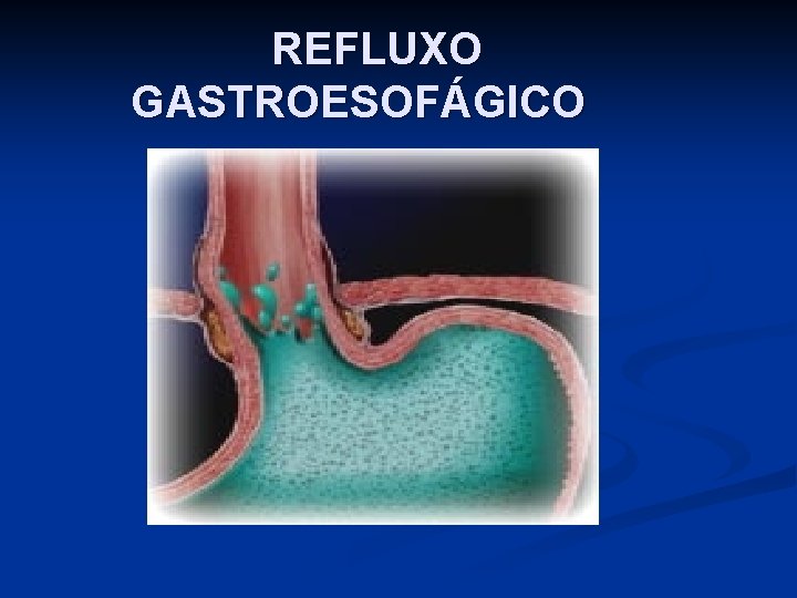 REFLUXO GASTROESOFÁGICO 