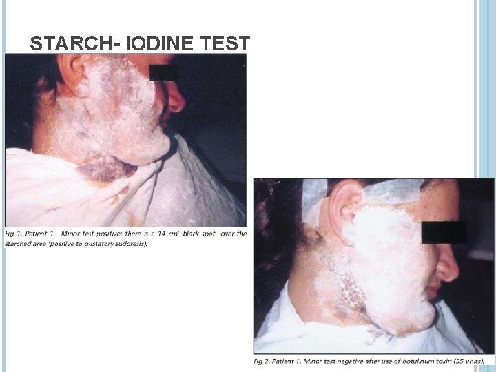 STARCH- IODINE TEST 