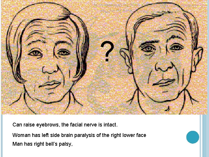 ? Can raise eyebrows, the facial nerve is intact. Woman has left side brain