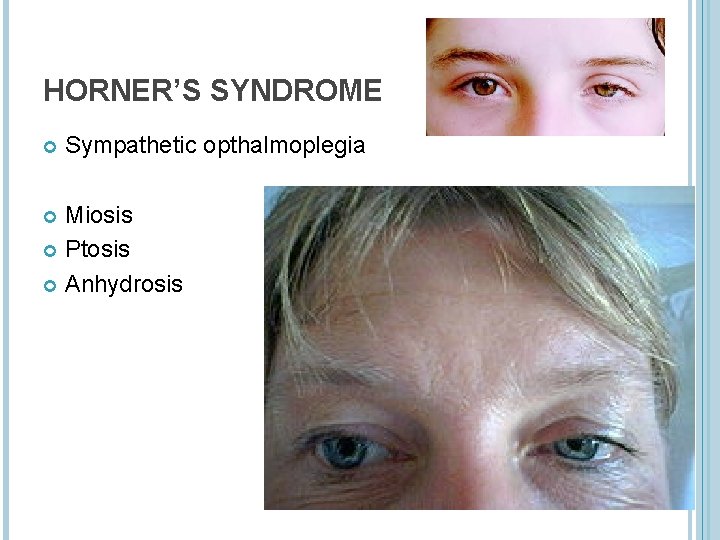 HORNER’S SYNDROME Sympathetic opthalmoplegia Miosis Ptosis Anhydrosis 