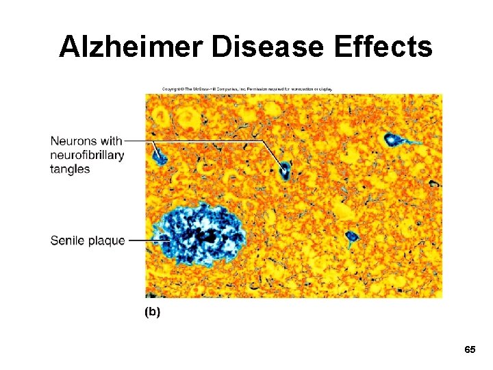 Alzheimer Disease Effects 65 