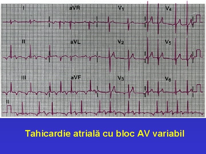 Tahicardie atrială cu bloc AV variabil 