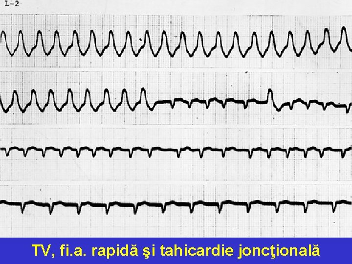 TV, fi. a. rapidă şi tahicardie joncţională 