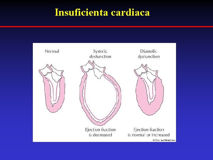 Insuficienta cardiaca 