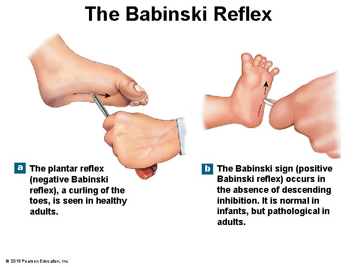 The Babinski Reflex a The plantar reflex (negative Babinski reflex), a curling of the
