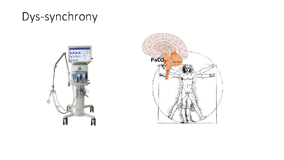 Dys-synchrony Pa. CO 2 