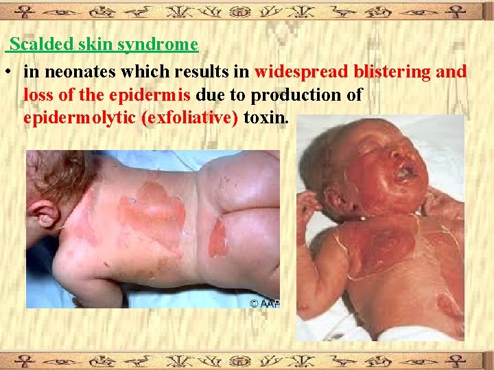 Scalded skin syndrome • in neonates which results in widespread blistering and loss of Scalded skin syndrome • in neonates which results in widespread blistering and loss of