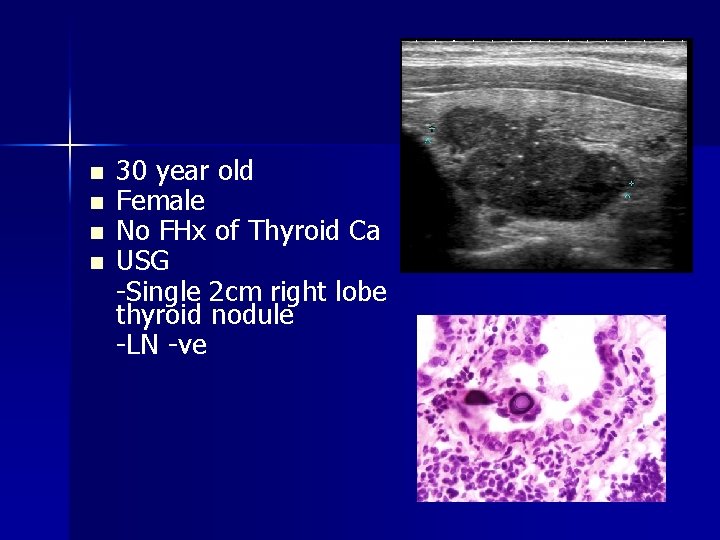n n 30 year old Female No FHx of Thyroid Ca USG -Single 2 n n 30 year old Female No FHx of Thyroid Ca USG -Single 2