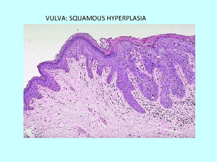 VULVA: SQUAMOUS HYPERPLASIA 