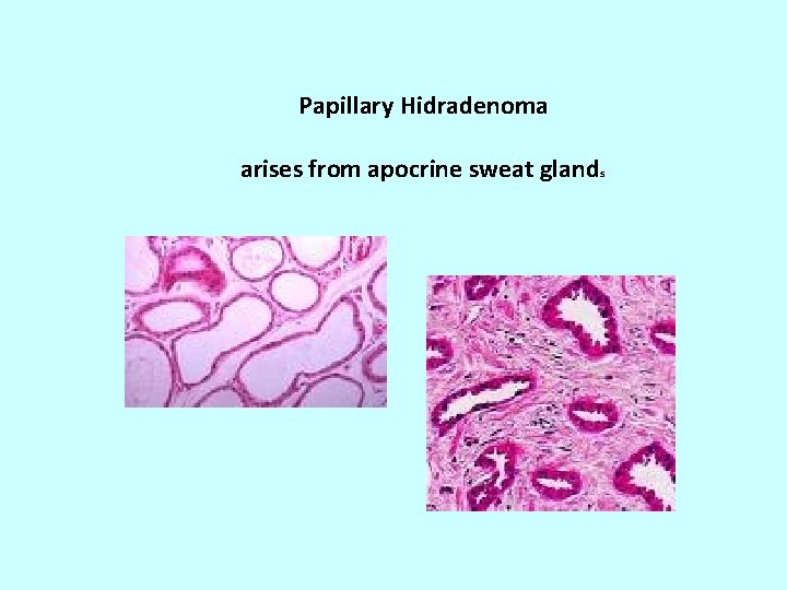 Papillary Hidradenoma arises from apocrine sweat glands 