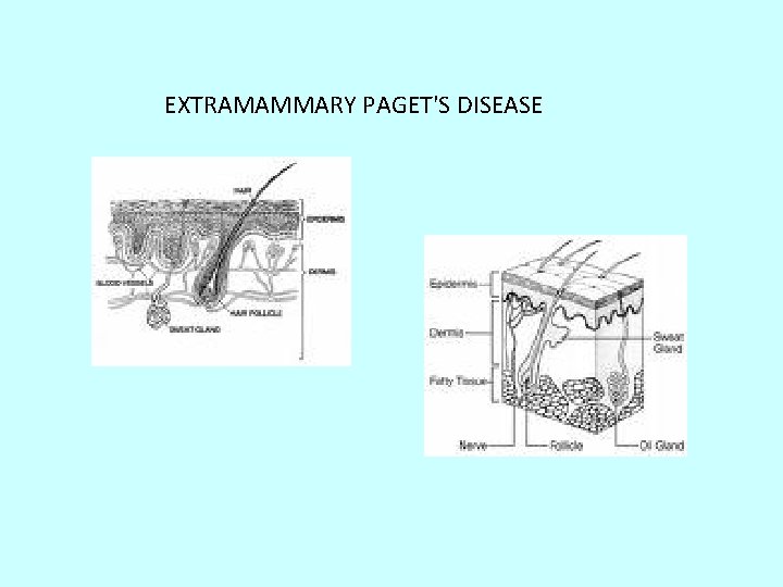 EXTRAMAMMARY PAGET'S DISEASE 